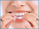 皓齿坊—专业牙齿美白护理